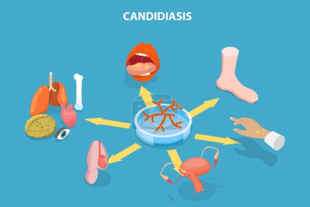 Illustration for 3D Isometric Flat Vector Illustration of Candidiasis, Medical Infographics - Royalty Free Image