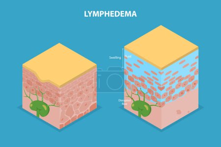 Illustration for 3D Isometric Flat Vector Illustration of Lymphedema, Disorder of Lymphatic System - Royalty Free Image