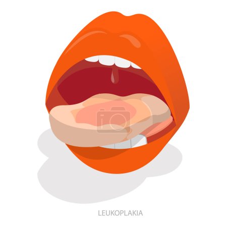 3D Isometric Flat Vector Illustration of Sore Or White Tongue, Definition of the Disease by Tongue. Item 1