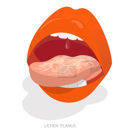 Ilustración de Ilustración plana isométrica 3D del dolor o de la lengua blanca, definición de la enfermedad por la lengua. Partida 2 - Imagen libre de derechos