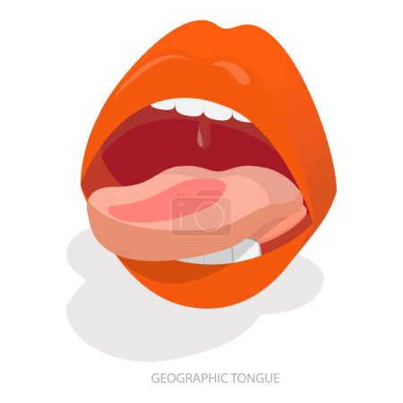 3D Isometric Flat Vector Illustration of Sore Or White Tongue, Definition of the Disease by Tongue. Item 3