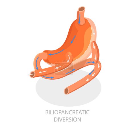Illustration for 3D Isometric Flat Vector Illustration of Types Of Bariatric Surgery, Sleeve Gastrectomy. Item 1 - Royalty Free Image