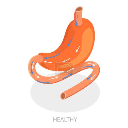 Illustration for 3D Isometric Flat Vector Illustration of Types Of Bariatric Surgery, Sleeve Gastrectomy. Item 4 - Royalty Free Image