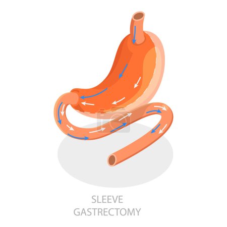 3D Isometric Flat Vector Illustration of Types Of Bariatric Surgery, Sleeve Gastrectomy. Item 5