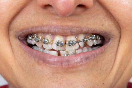 Metallspangen an Zähnen einer indischen (britisch-asiatischen) Frau mittleren Alters. Mündlich, lächelnd.