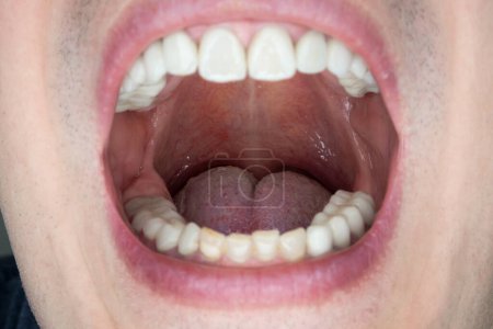 Photo for Caucasian male open oral cavity, close up shot. - Royalty Free Image