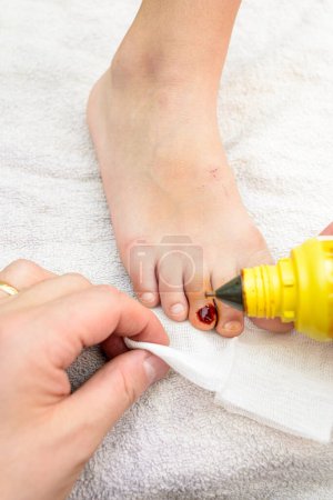 Erste-Hilfe-Nahaufnahme einer Verletzung des Zehennagels eines Kindes. Im Sommer sind kleine Unfälle zu Hause und Verletzungen an den nackten Füßen an der Tagesordnung
