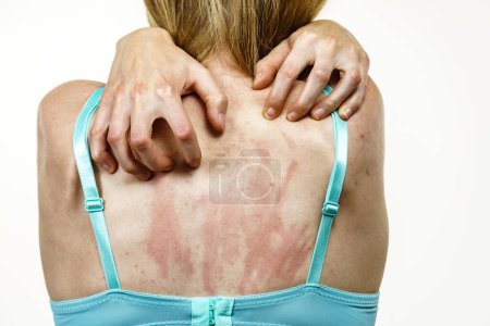 Mujer joven que sufre de picazón en la piel y arañazos picazón en la espalda. Reacción alérgica a los alimentos, dermatitis. Asistencia sanitaria.