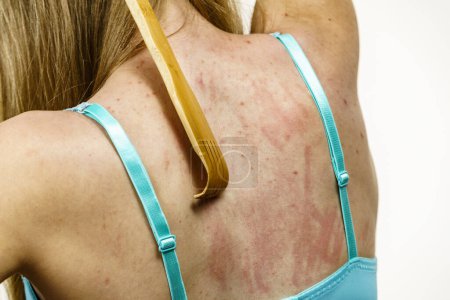 Itchy skin, dermatitis, food allergies. Woman using scratching wood stick to scratch her back side. Female having itching, allergy rash.