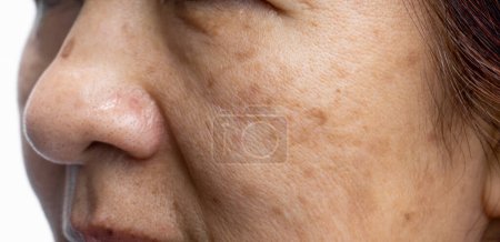 Frauen in den Wechseljahren machen sich Sorgen über Melasma im Gesicht.