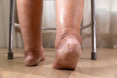 La jambe de la femme est un ?dème (gonflement) après le traitement du cancer.