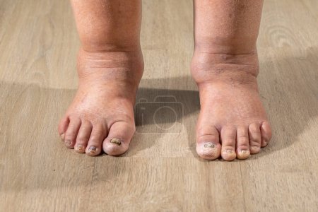 Photo for Cancer chemotherapy cause swelling of ankles (ankle oedema) , - Royalty Free Image