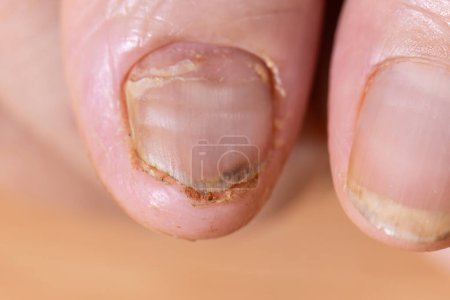 Cancer chemotherapy cause nails brittle or flaky.