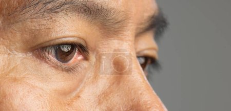 Photo for Senior man has cataracts. Generally, cataracts are common in older people. - Royalty Free Image