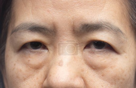Senior asiatische Frau sorgen sich um Augenbeutel und dunklen Fleck.
