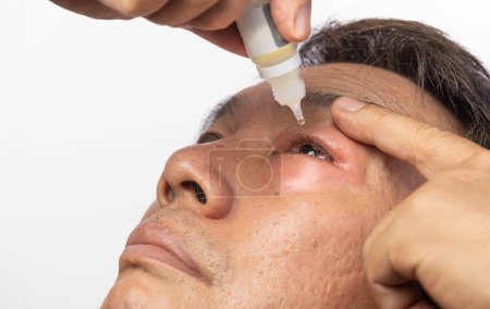 Hombre mayor uso de gotas antibióticas para los ojos para tratar el ojo hinchado de la picadura de insectos.