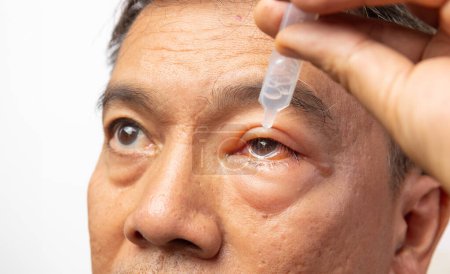 Hombre mayor utilizar lágrimas artificiales para tratar el ojo hinchado de la picadura de insectos.