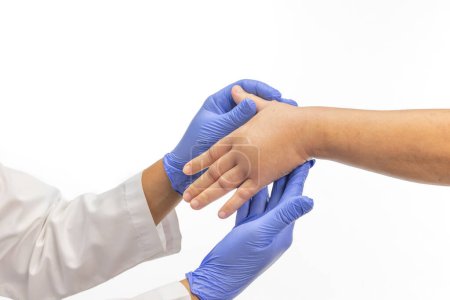Geschwollene Hand nach Insektenstichen. Hautallergische Behandlung.