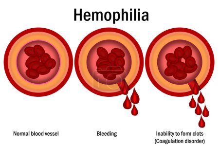 Hämophilie. beschädigtes Blutgefäßkonzept isoliert, 3D-Darstellung