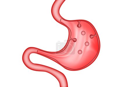 Pólipos estomacales del sistema digestivo, renderizado 3D