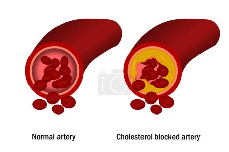 Foto de Colesterol en la arteria. Concepto médico, representación 3d - Imagen libre de derechos