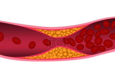 Colesterol en la arteria. Concepto médico, representación 3d
