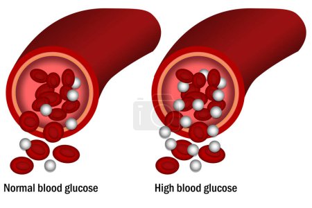 Foto de Alta glucosa en sangre aislada con fondo blanco, 3d renderizado - Imagen libre de derechos