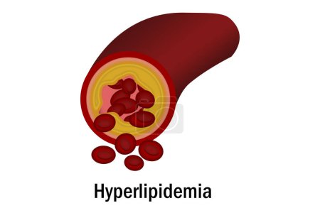 Hiperlipidemia con vaso sanguíneo aislado, renderización 3d