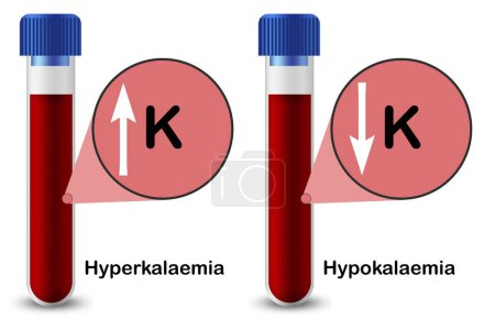 Hyperkalaemia and Hypokalaemia with test sample in test tube, 3d rendering