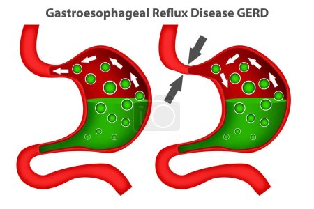 Heartburn or gastroesophageal reflux disease., 3d rendering