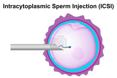 Photo for Intracytoplasmic sperm injection (ICSI) process diagram, 3d rendering - Royalty Free Image