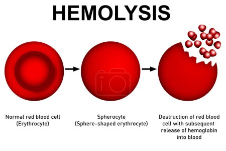 Diagrama científico y proceso de hemólisis, representación 3d