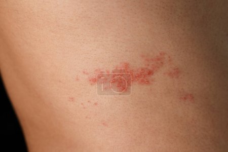 Photo for Man with shingles disease, skin infected with Herpes zoster, virus, Healthcare and medical. - Royalty Free Image