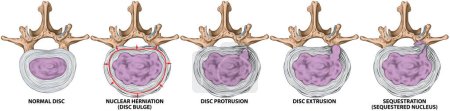 Photo for Types and stages of lumbar disc herniation, herniated disc, nuclear herniation, disc bulge, protrusion, extrusion, sequestration, lumbar vertebra, intervertebral disk, vertebral bones, superior view - Royalty Free Image
