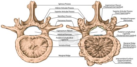 Segunda vértebra lumbar, columna lumbar, hueso vertebral, artrosis no cubierta avanzada, cambios degenerativos vértebra, osteófitos, espondilofitos, osteoartritis de las articulaciones, vista superior  