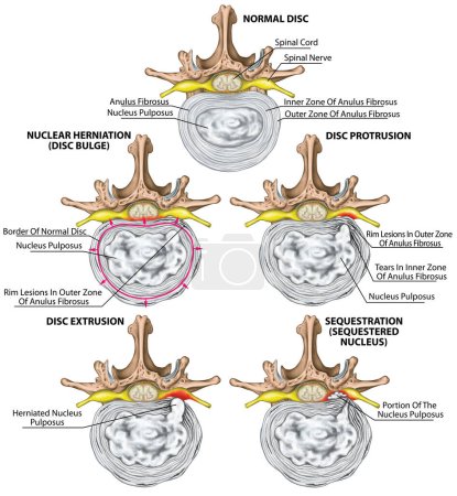 Nerves, types and stages of lumbar disc herniation, herniated disc, nuclear herniation, disc bulge, protrusion, extrusion, sequestration, lumbar vertebra, intervertebral disk, vertebral bones, superior view