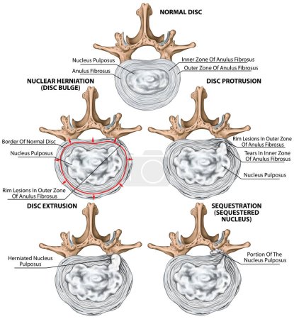 Tipos y etapas de hernia discal lumbar, hernia discal, hernia nuclear, protuberancia discal, protrusión, extrusión, secuestro, vértebra lumbar, disco intervertebral, huesos vertebrales, vista superior