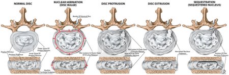 Types and stages of lumbar disc herniation, herniated disc, nuclear herniation, disc bulge, protrusion, extrusion, sequestration, lumbar vertebra, intervertebral disk, vertebral bones, superior view