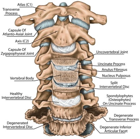 Changements dégénératifs dans la colonne cervicale, processus unciné, arthrose non couverte, anatomie du système osseux humain, articulation non couverte, disque intervertébral fractionné, section coronale, vue antérieure