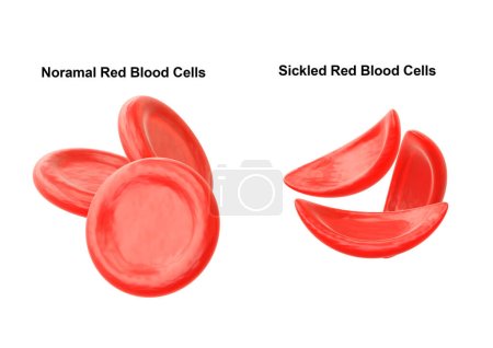 Sickle cell anemia is a hereditary disease characterized by the alteration of red blood cells, making them look like a sickle. 3D illustration