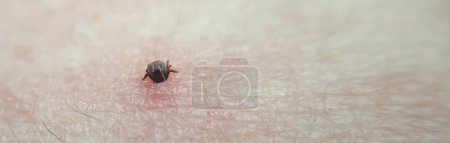 tick Macro photo on human skin. Ixodes ricinus. Bloated parasite bitten into pink irritated epidermis