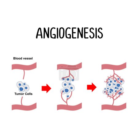 Ilustración de Angiogénesis: formación de nuevos vasos sanguíneos, a menudo estimulados por células cancerosas para asegurar un suministro suficiente de nutrientes para el crecimiento tumoral. - Imagen libre de derechos