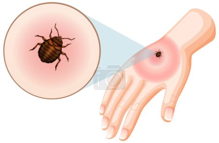 Bed bug bites sting on skin illustration