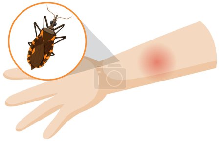 Téléchargez les illustrations : Human arm swollen from kissing bug bite illustration - en licence libre de droit