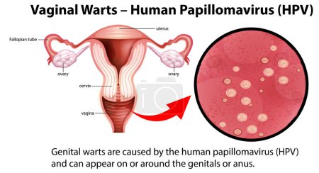 Illustration for Vaginal Warts - Human Papillomavirus (HPV) infographic with explanation illustration - Royalty Free Image