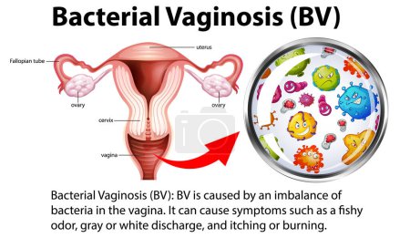 Téléchargez les illustrations : Infographie sur la vaginose bactérienne (VB) avec illustration explicative - en licence libre de droit
