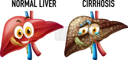 Illustration for Normal liver and cirrhosis illustration - Royalty Free Image