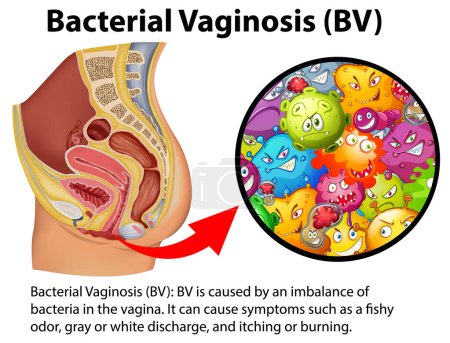 Illustration for Bacterial Vaginosis (BV) infographic with explanation illustration - Royalty Free Image