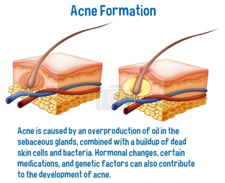 Ilustración de Información de formación del acné explicación ilustración - Imagen libre de derechos