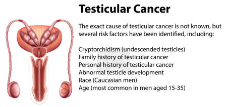Ilustración de Infografía del cáncer testicular con ilustración explicativa - Imagen libre de derechos